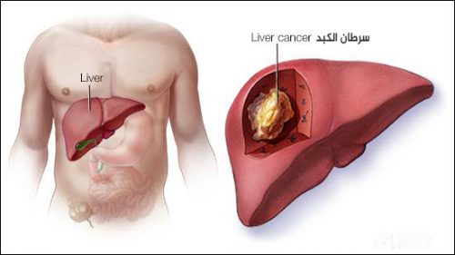 صورة توضيحية لسرطان الكبد