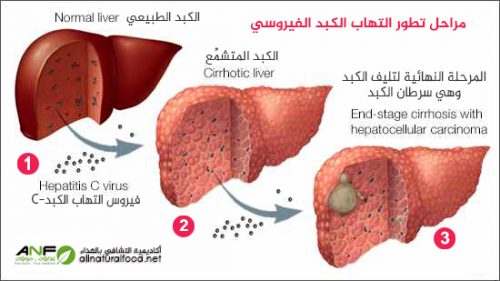 مراحل تطور سرطان الكبد
