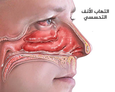 التهاب الأنف التحسسي