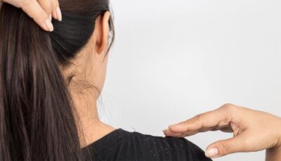 زيت جوز الهند يمنع تساقط الشعر