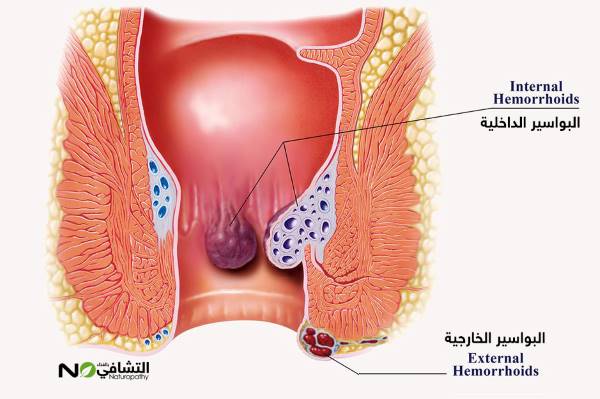 مقطع تشريحي يوضح الفرق بين البواسير الداخلية والخارجية -التشافي بالغذاء