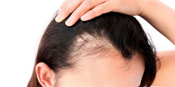 تساقط الشعر بسبب خمول الغدة الدرقية