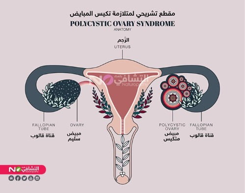 مقطع تشريحي لتكيس المبايض-التشافي بالغذاء