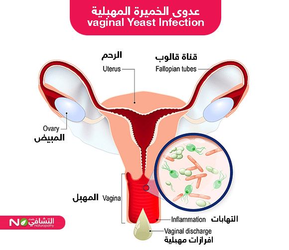 مقطع تشريحي يوضح التهابات المهبل-التشافي بالغذاء
