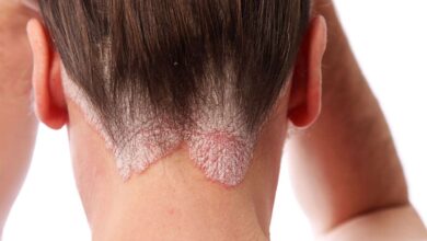 7 طرق منزلية فاعلة لعلاج الصدفية-التشافي بالغذاء
