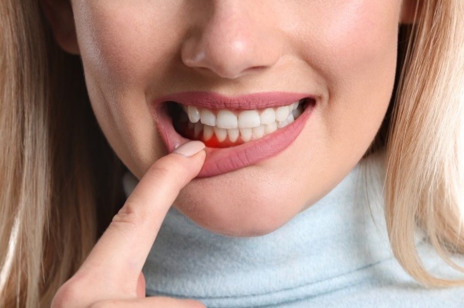 8 طرق منزلية فاعلة لعلاج التهاب اللثة-التشافي بالغذاء