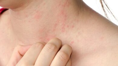 علاج الأكزيما، 5 أدوية منزلية فاعلة-التشافي بالغذاء