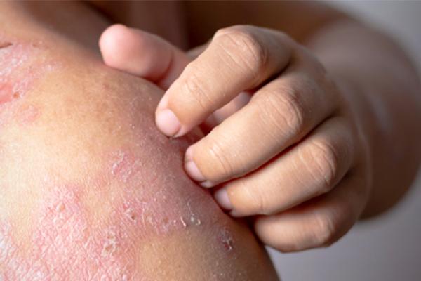 تعد الزيوت الطبيعية طريقة رائعة لمكافحة الأكزيما-التشافي بالغذاء