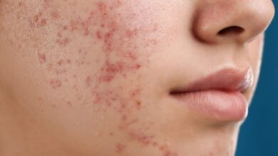 هل تساعد بكتيريا حب الشباب في تعزيز صحة الجلد حقاً؟-التشافي بالغذاء