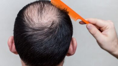 رجل يعاني من الصلع الوراثي-التشافي بالغذاء